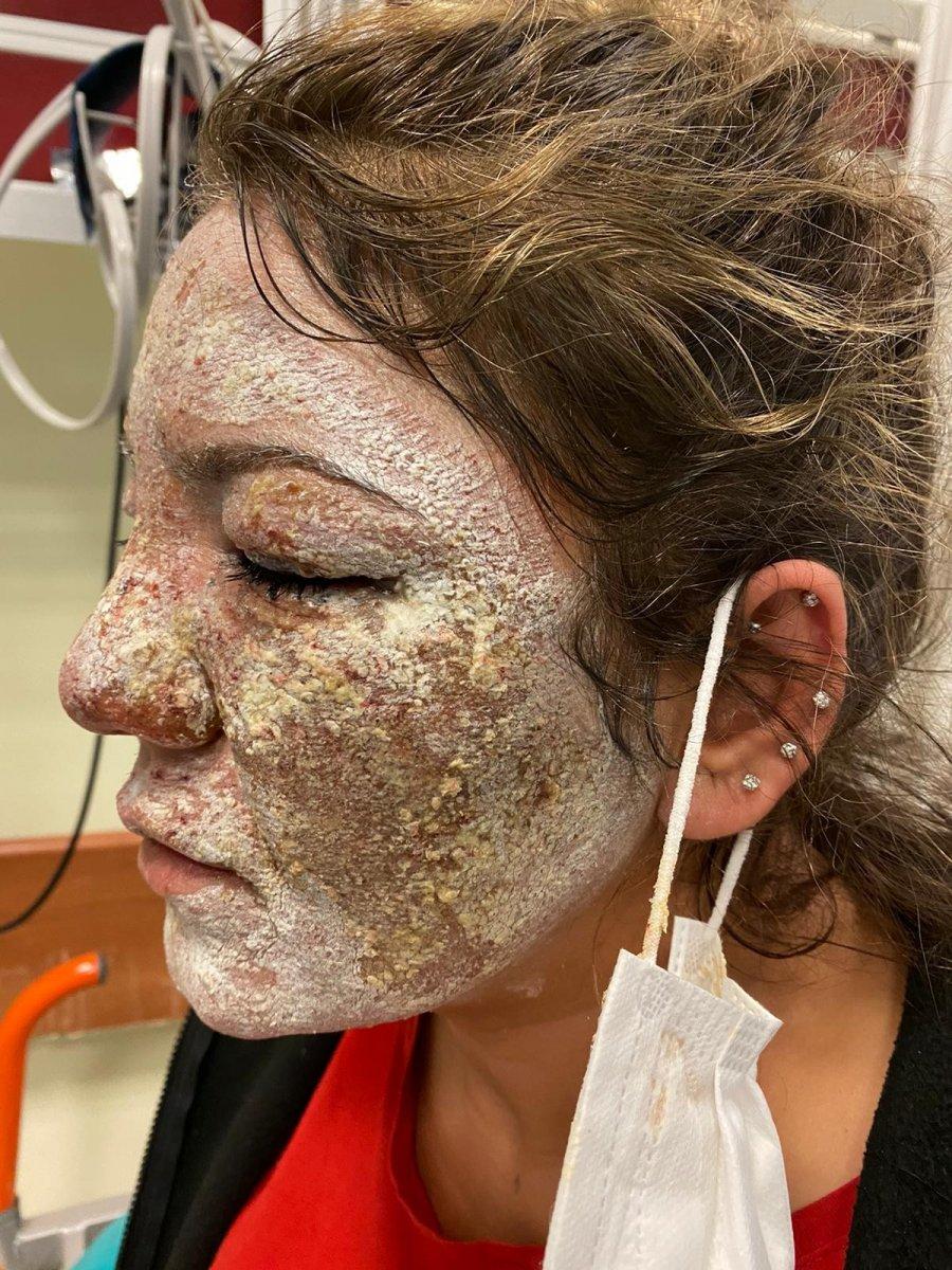 Kahramanmaraş'ta güzellik merkezine giden kadının yüzü yandı