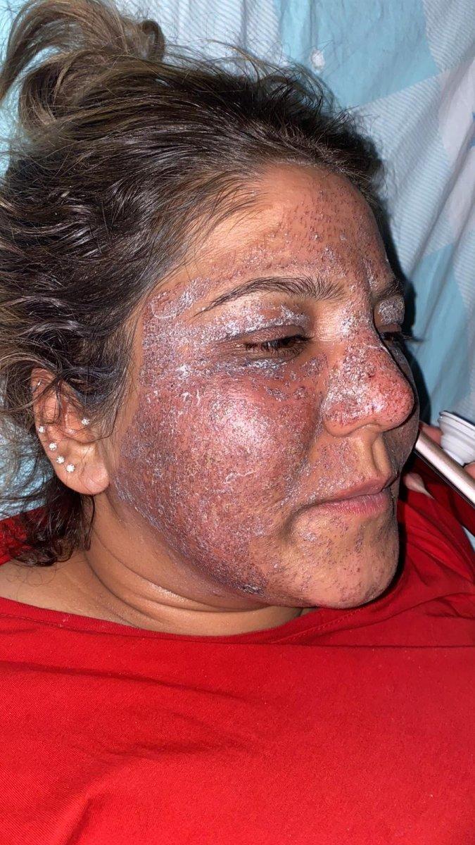 Kahramanmaraş'ta güzellik merkezine giden kadının yüzü yandı