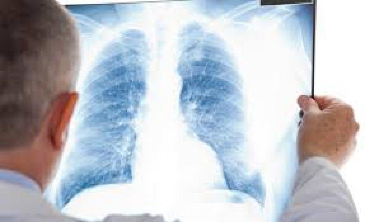 Silikozis hastalığı nedir, belirtileri neler? Silikozis hangi mesleklerde görülür?