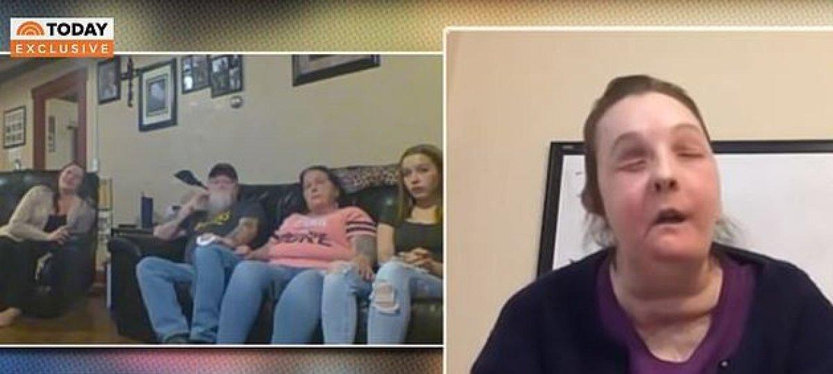 ABD'de ikinci kez yüz nakli yapılan kadın, kameralar karşısına geçti