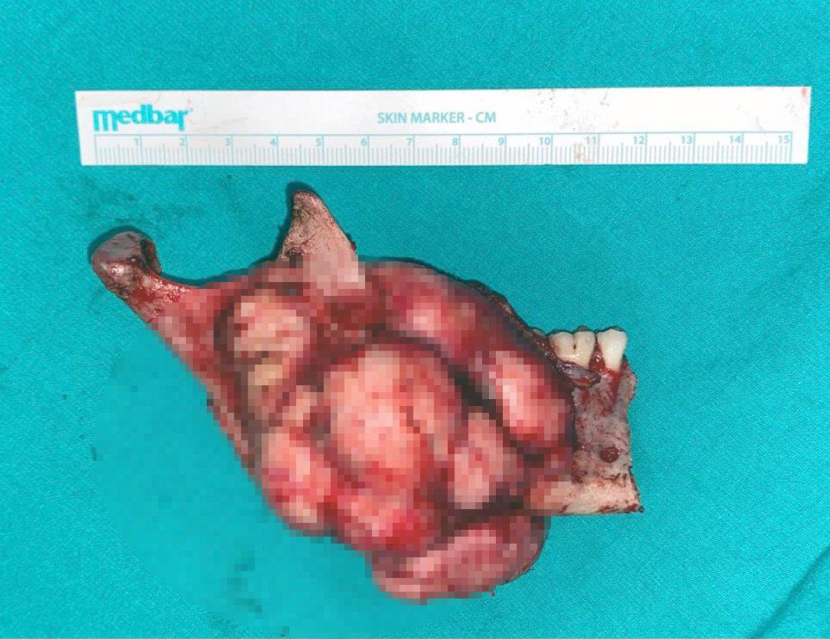 İstanbul’da üniversite öğrencisi çenesindeki tümörden ameliyatla kurtuldu