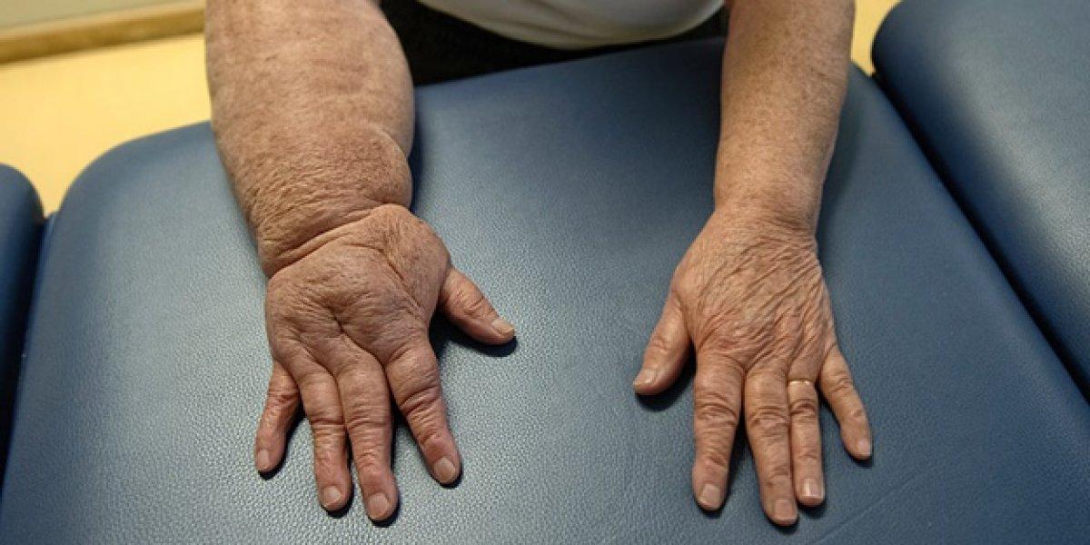 6 Mart Dünya Lenfödem Farkındalık Günü! Lenfödem (fil hastalığı) belirtileri nelerdir, tedavisi var mı?