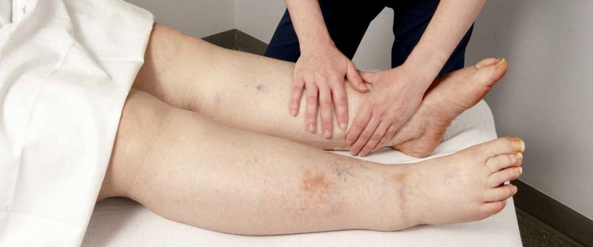 6 Mart Dünya Lenfödem Farkındalık Günü! Lenfödem (fil hastalığı) belirtileri nelerdir, tedavisi var mı?