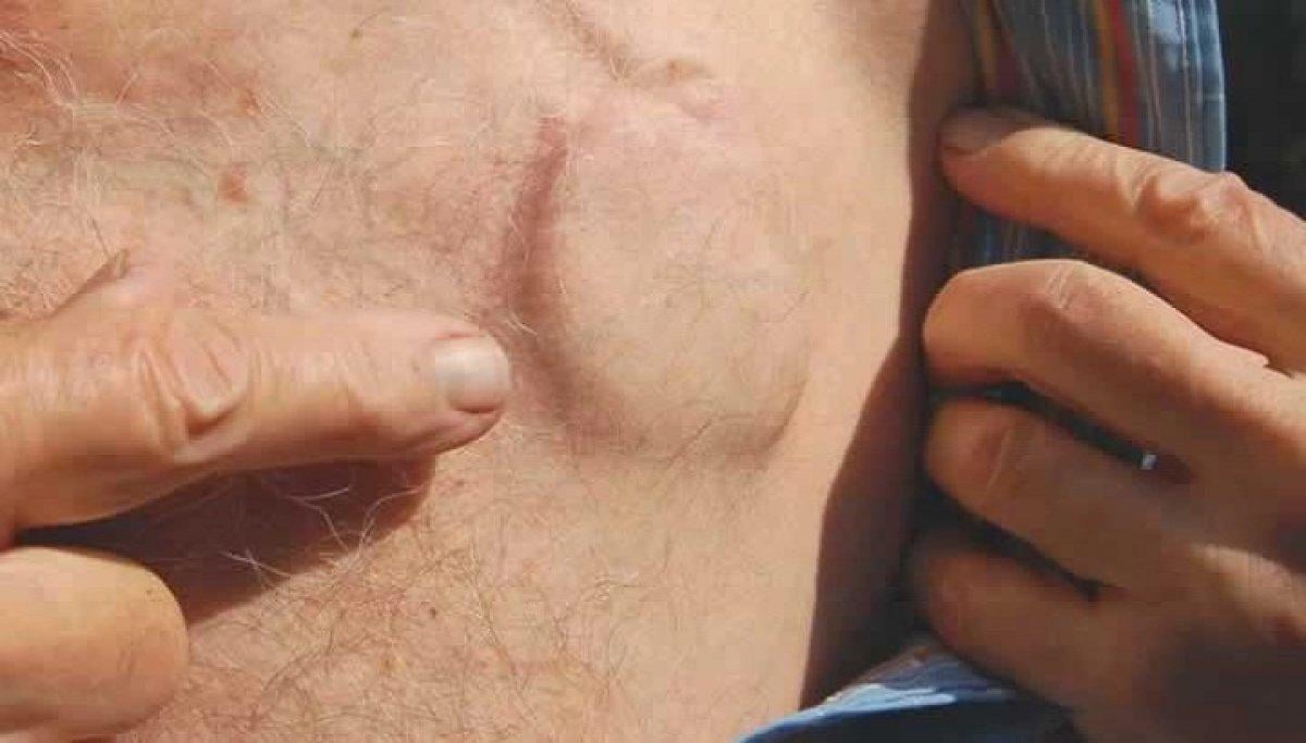 Kalp pili nedir, ne işe yarar? Kalp pili neden ve nasıl takılır?