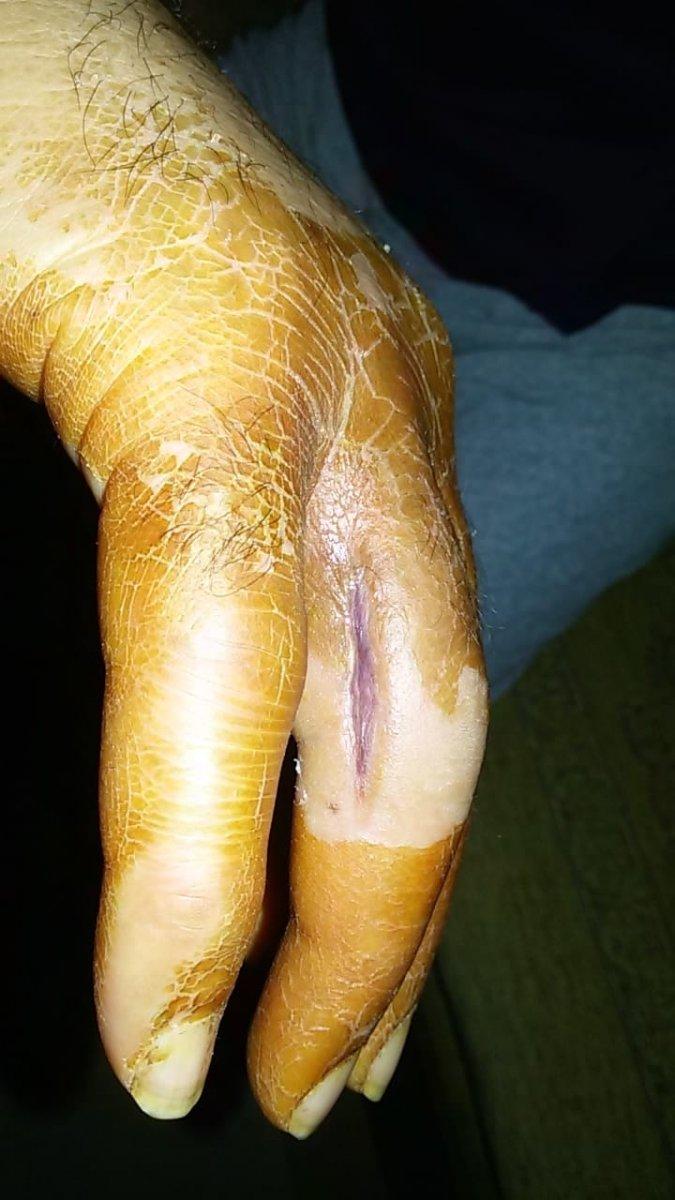 Nişantaşı'nda garsonun eline batan kürdan kabusu oldu