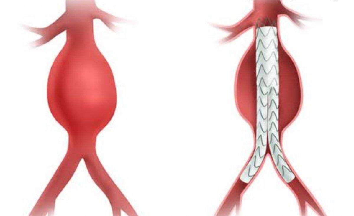 İstanbul'da karnında 9.5 santimlik şişlik tespit edilen adam doktorları şaşırttı