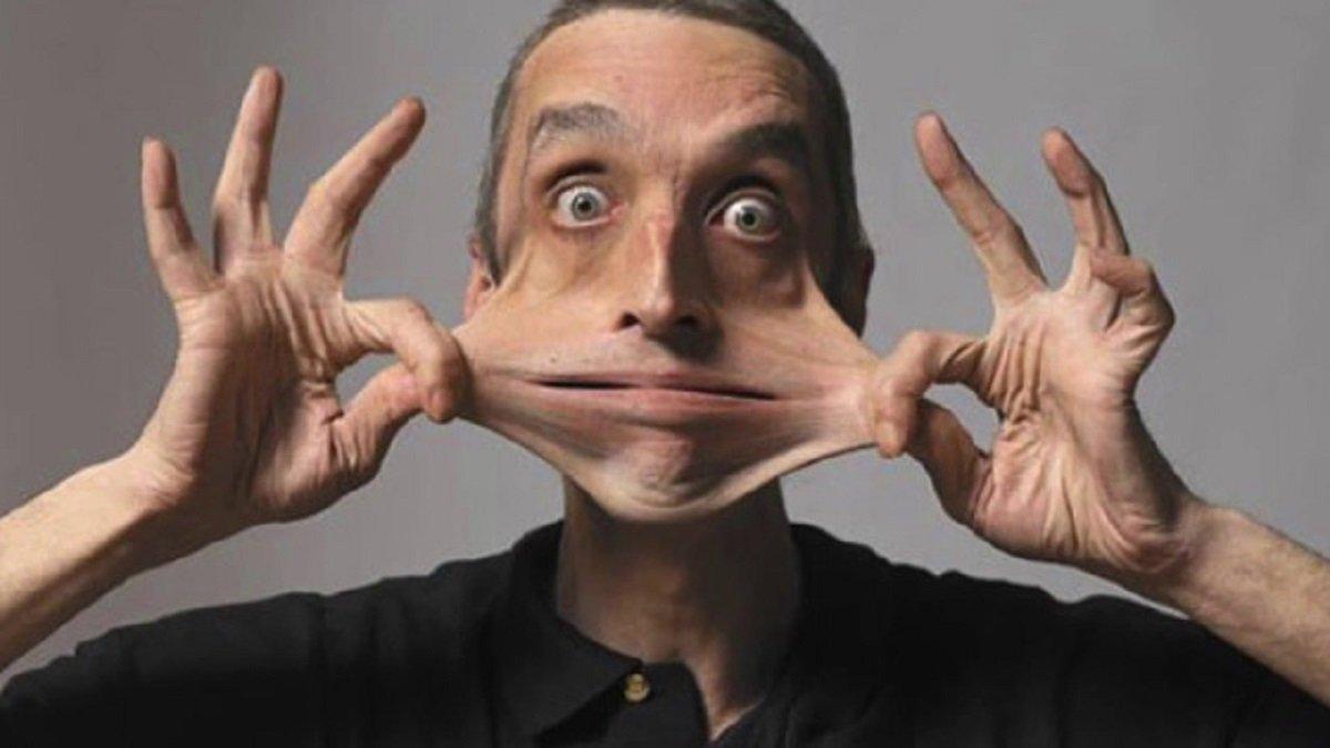 Ehlers Danlos Sendromu nedir, belirtileri nelerdir? Ehlers Danlos (EDS) Sendromu tedavisi var mı?