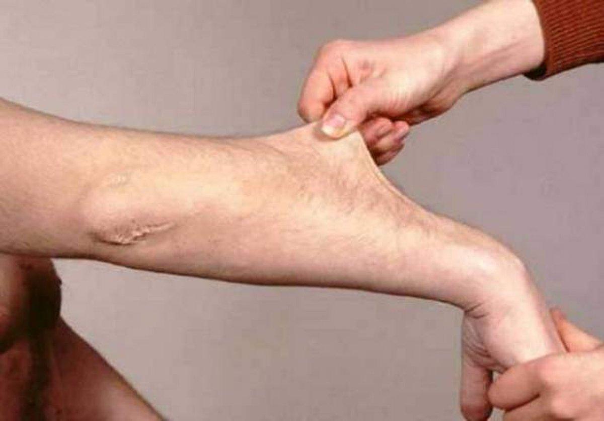 Ehlers Danlos Sendromu nedir, belirtileri nelerdir? Ehlers Danlos (EDS) Sendromu tedavisi var mı?