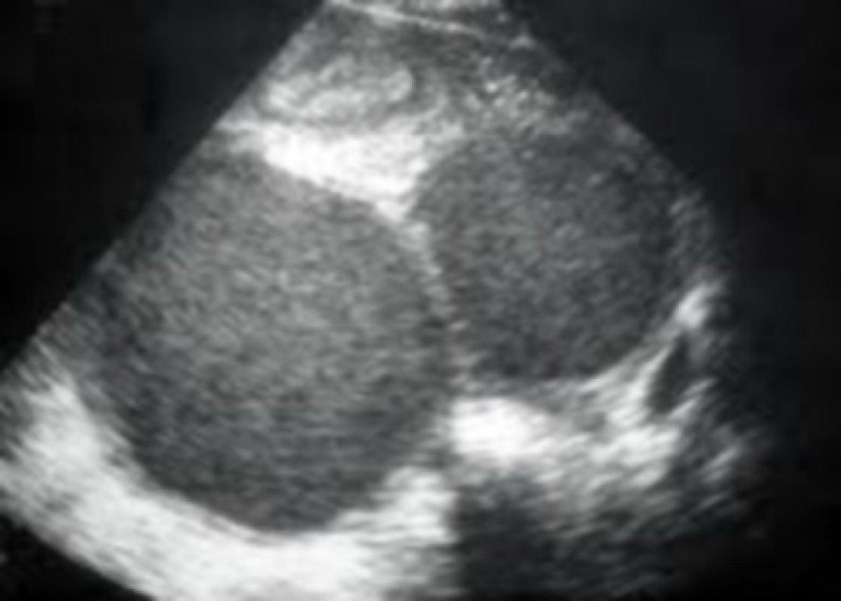 Çikolata kisti nedir, tehlikeli midir? Çikolata kisti (Endometriozis) belirtileri nelerdir?