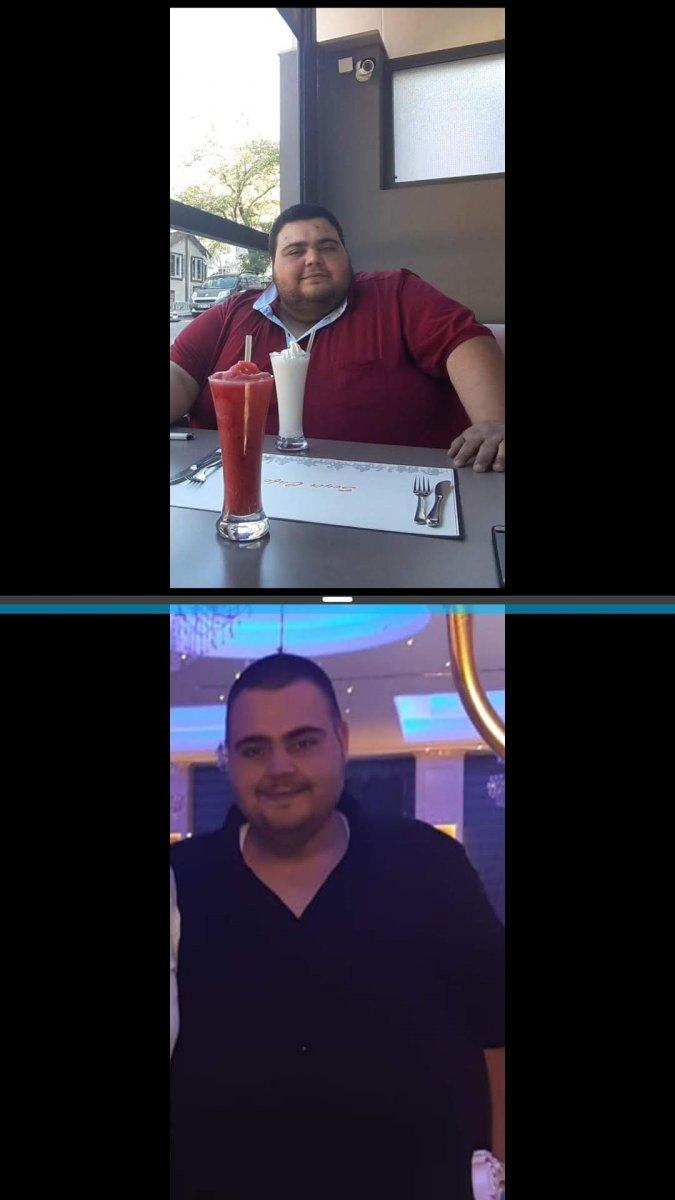 Ankaralı esnaf, mide küçültme ameliyatı ile 129 kilo verdi