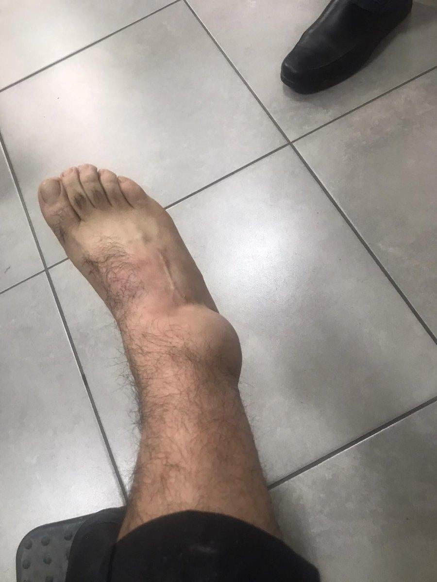 Manisa'da iki polis pitbull saldırısına uğradı