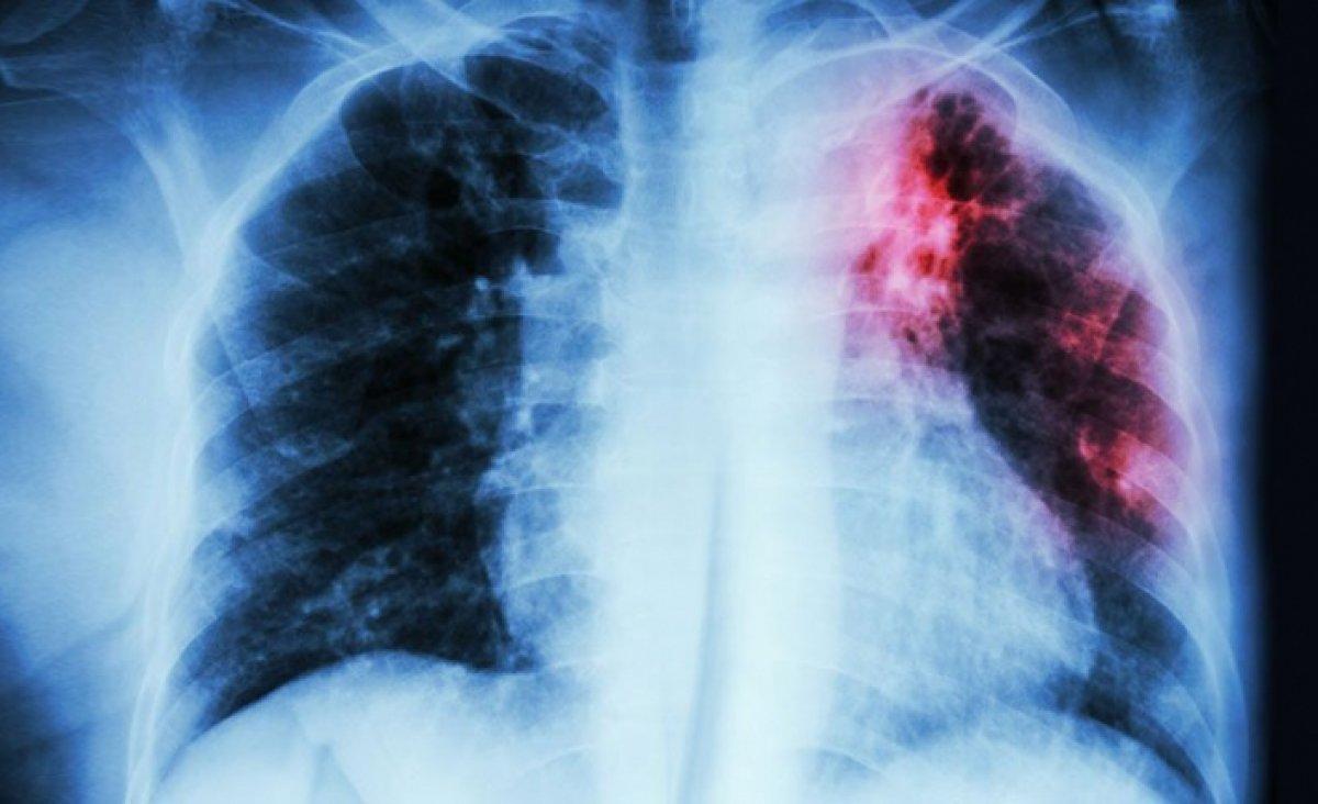 24 Mart Dünya Tüberküloz Günü: Tüberküloz nedir, belirtileri nelerdir?