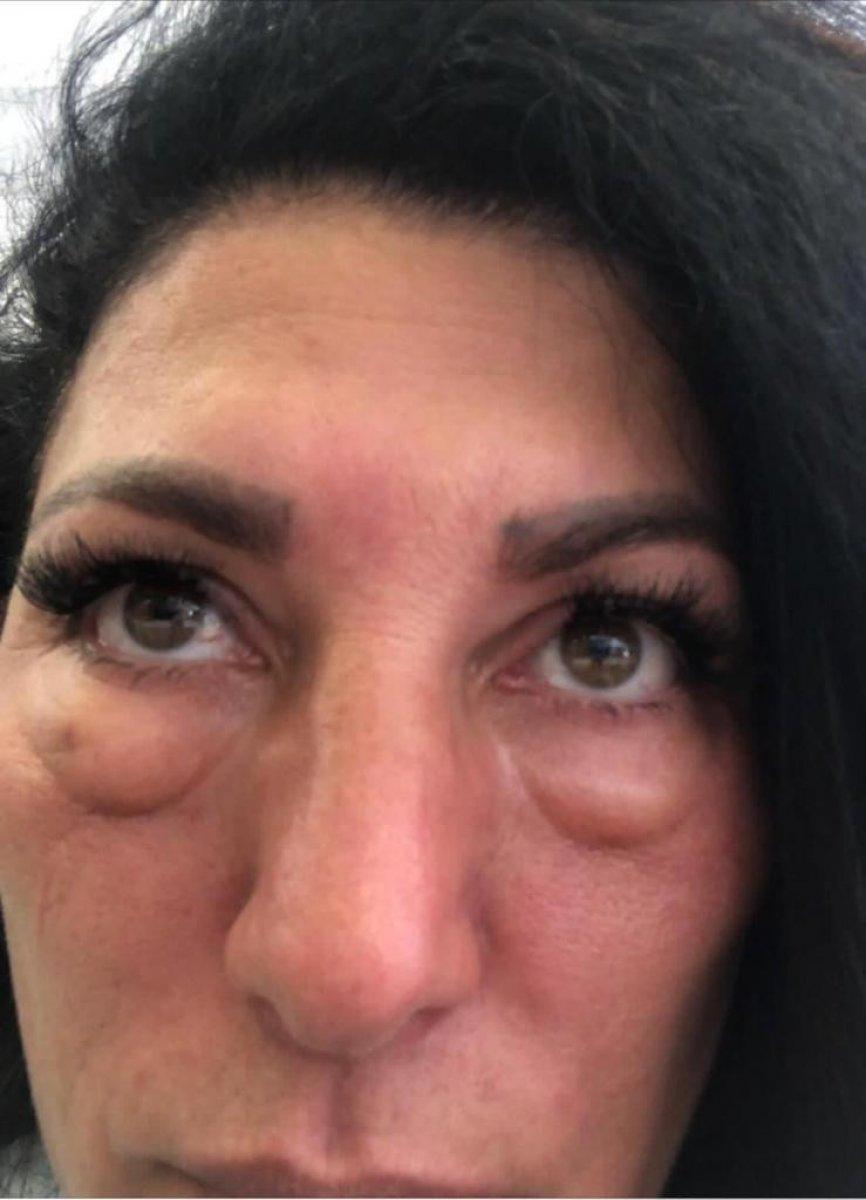 İstanbul'da dolgu yaptıran kadın yüz felci geçirdi