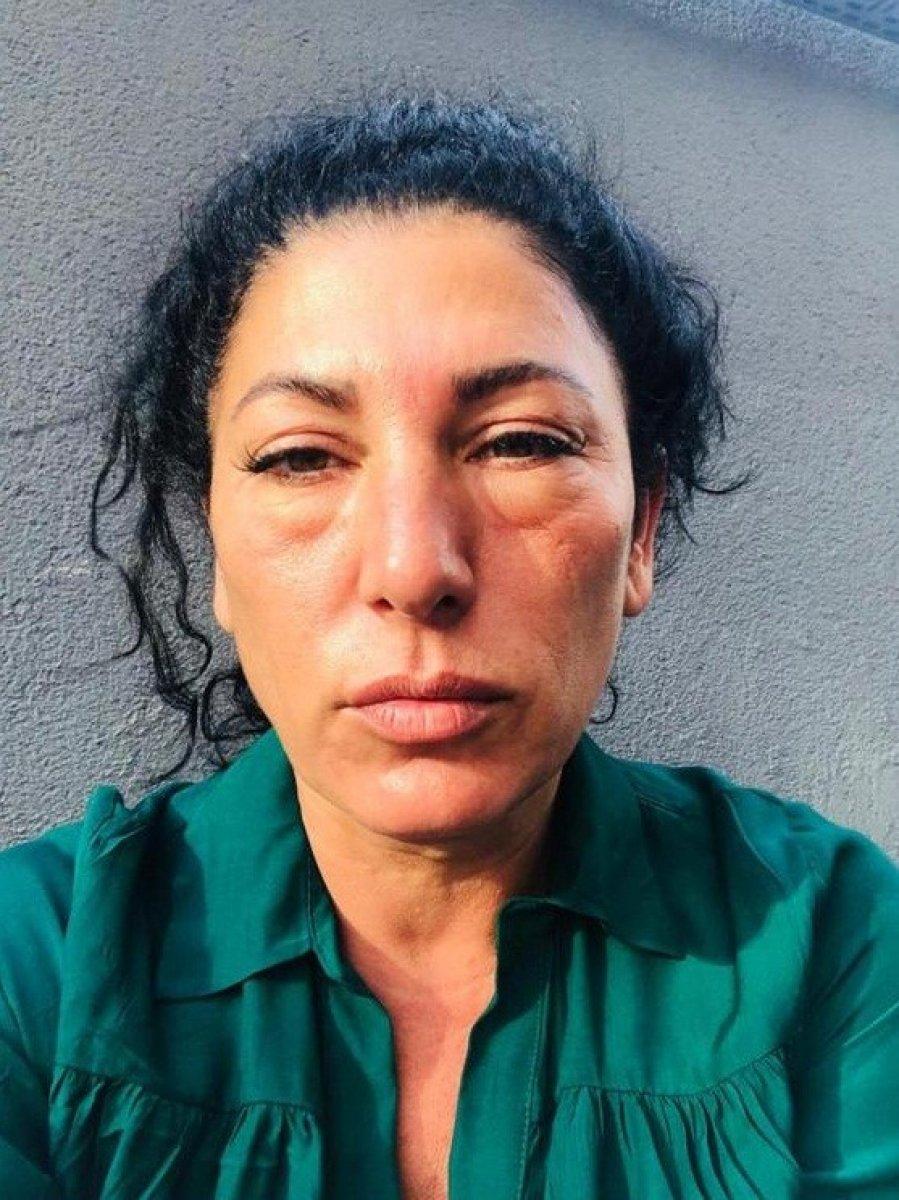 İstanbul'da dolgu yaptıran kadın yüz felci geçirdi