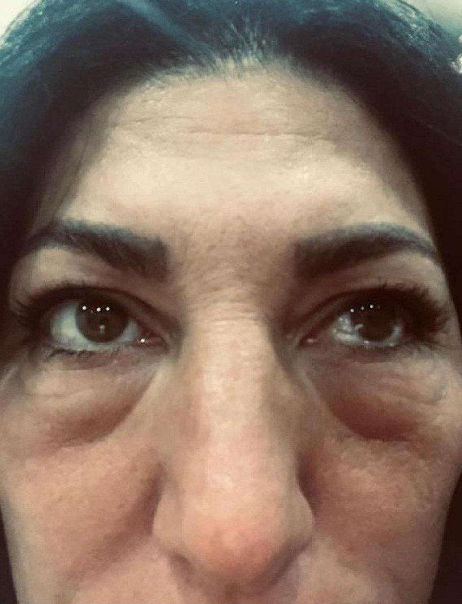 İstanbul'da dolgu yaptıran kadın yüz felci geçirdi