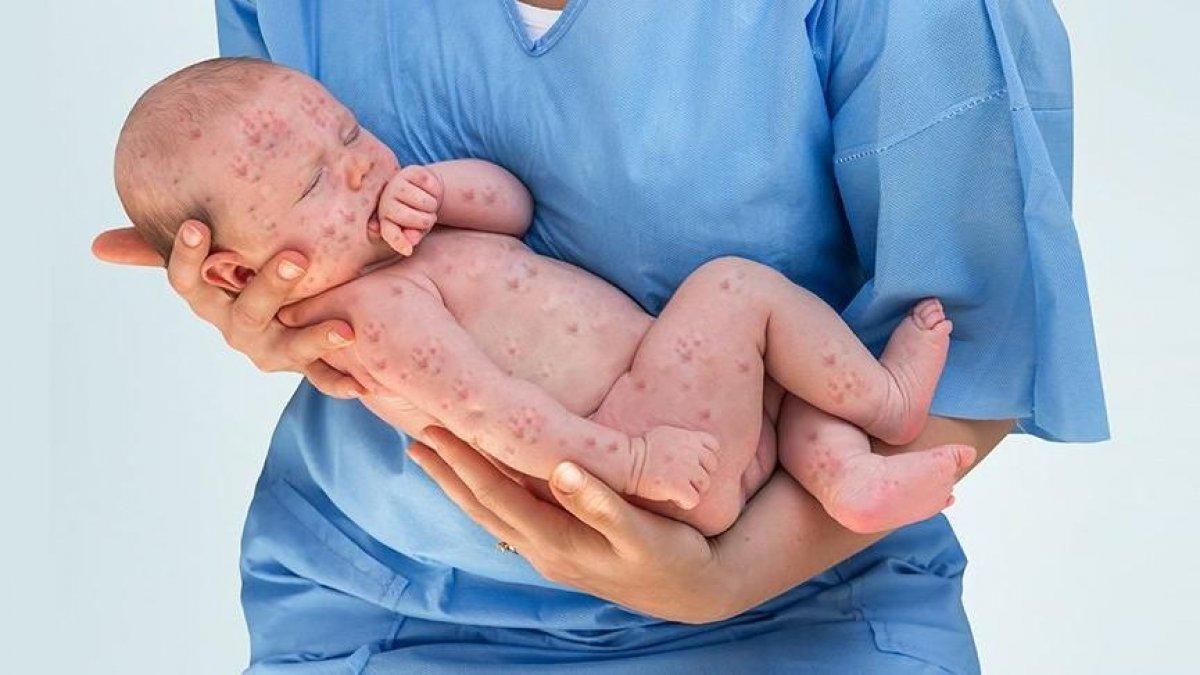 Kızıl hastalığı nedir, belirtileri nelerdir? Kızıl hastalığı tedavisi var mı?