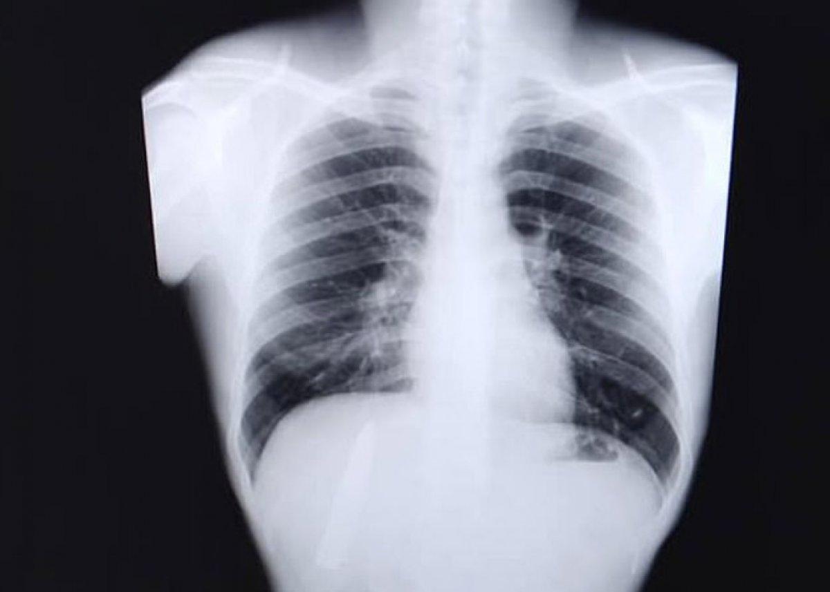 Filipinler'de vücudundaki bıçakla 15 ay yaşadı