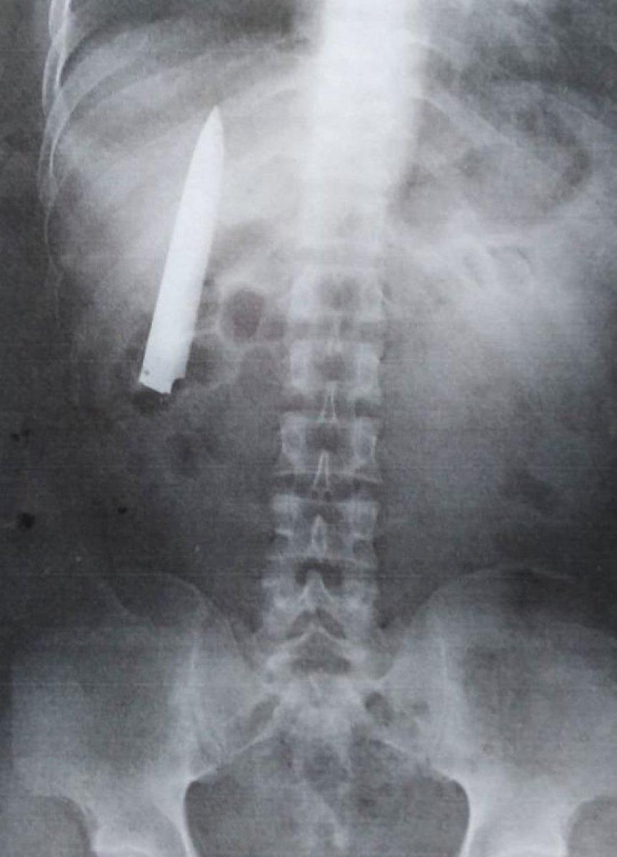 Filipinler'de vücudundaki bıçakla 15 ay yaşadı