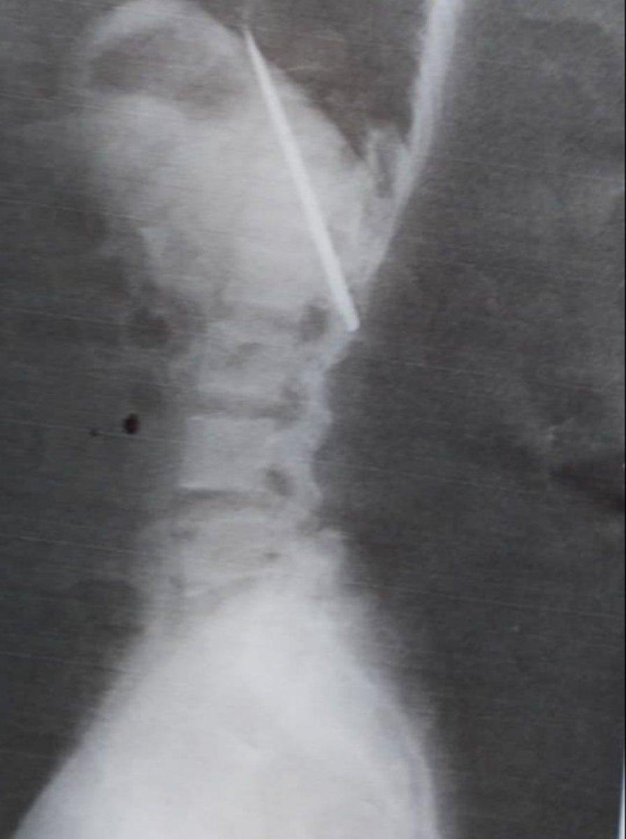 Filipinler'de vücudundaki bıçakla 15 ay yaşadı