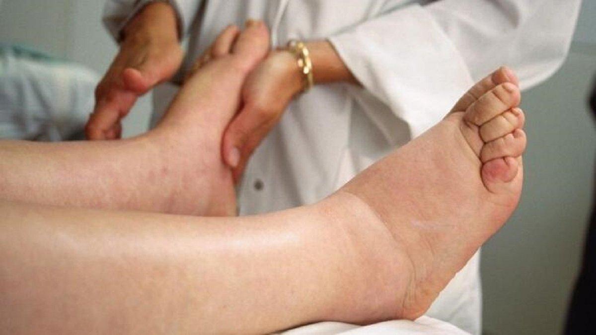 Lenfödem belirtileri ve tedavi yöntemleri