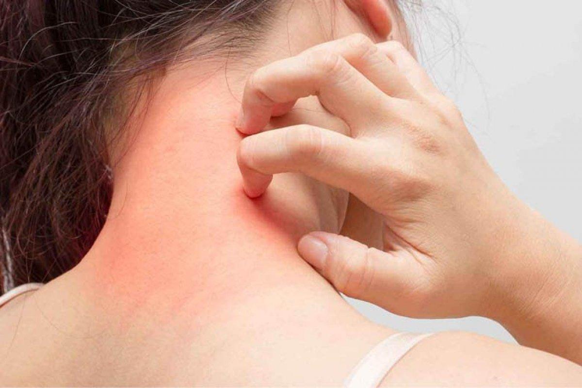 Uyuz hastalığı nedir, belirtileri nelerdir? Uyuz hastalığı nasıl geçer, tedavisi var mı?