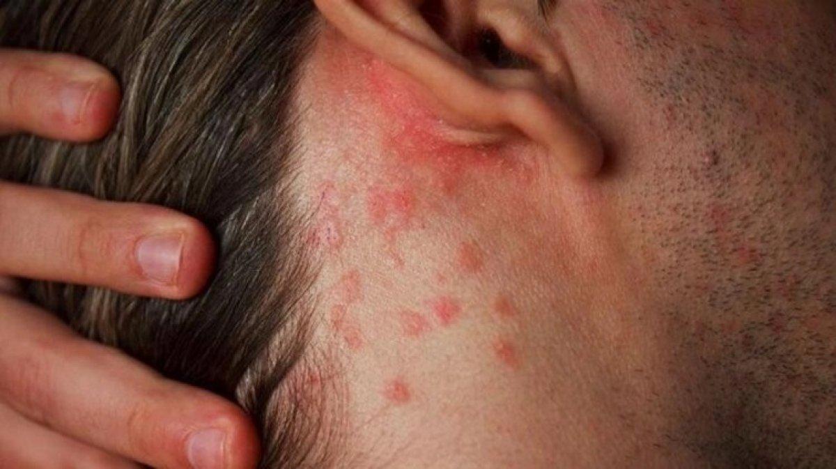 Uyuz hastalığı nedir, belirtileri nelerdir? Uyuz hastalığı nasıl geçer, tedavisi var mı?