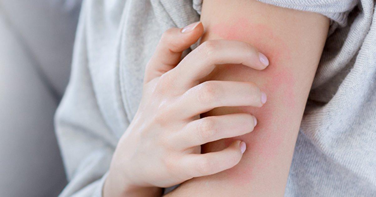 Uyuz hastalığı nedir, belirtileri nelerdir? Uyuz hastalığı nasıl geçer, tedavisi var mı?