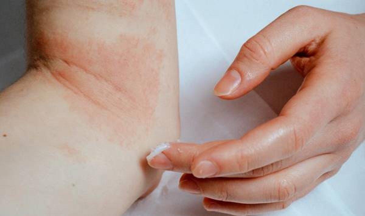 Atopik dermatit nedir