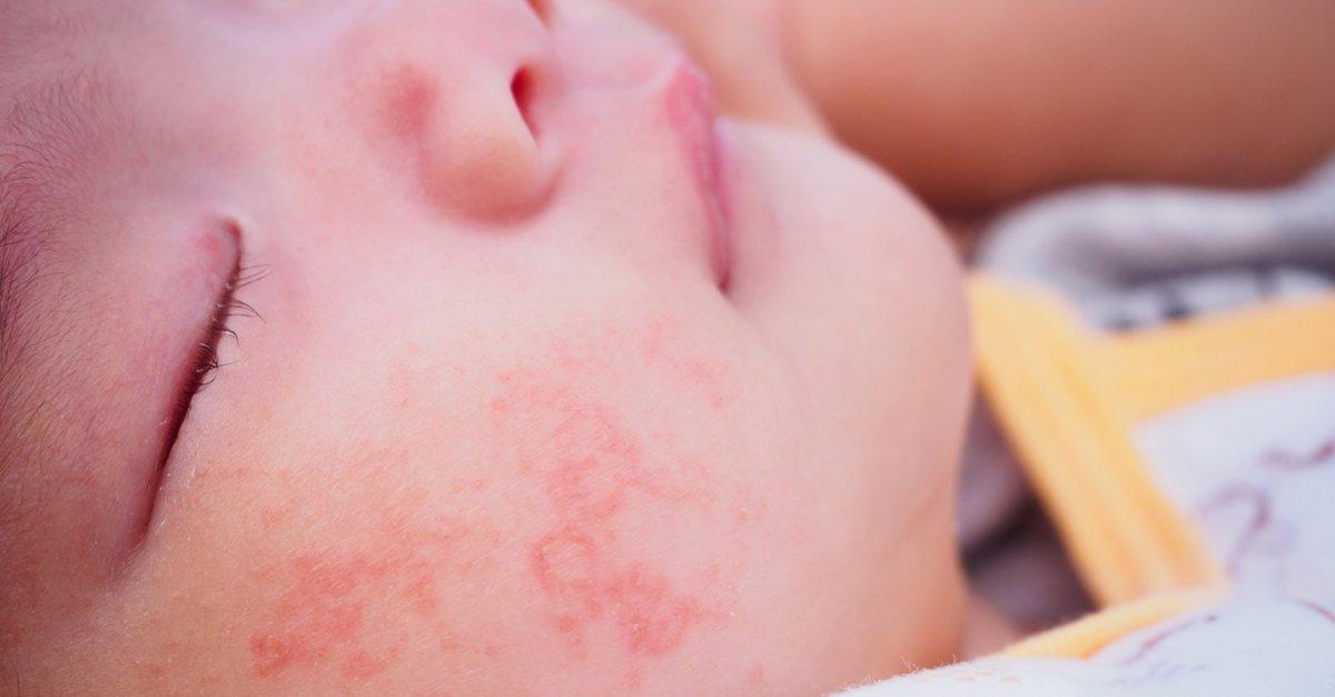 Atopik dermatit nedir