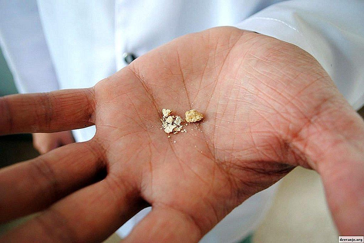 Böbrek taşını gösteren ilk belirtiler