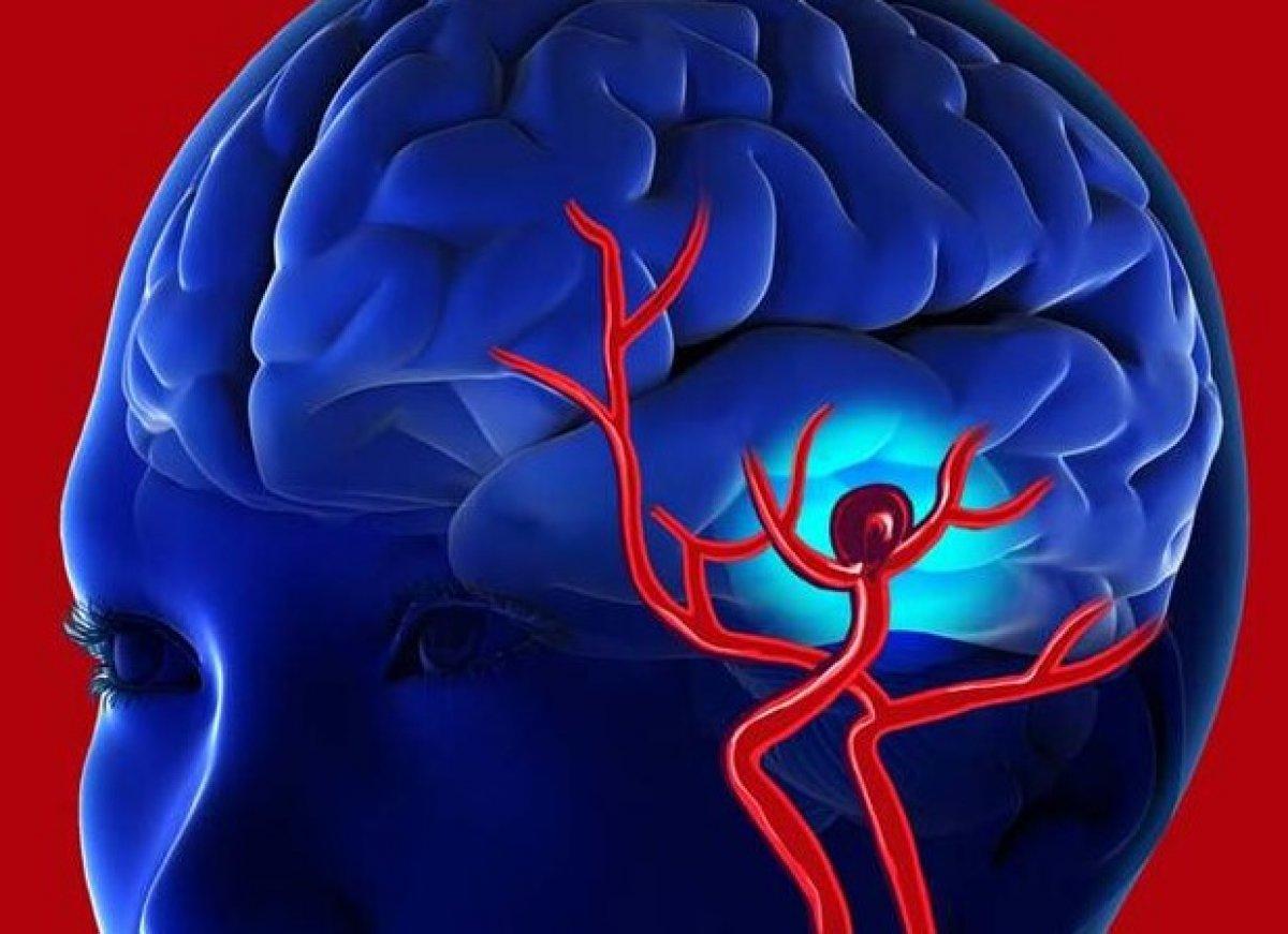 Kanada'da yeni bir beyin hastalığı keşfedildi