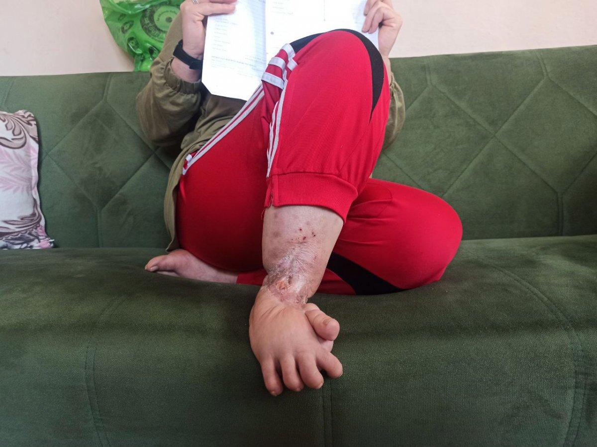 Mersin'de vücuduna iltihap yayılan kadın yardım bekliyor