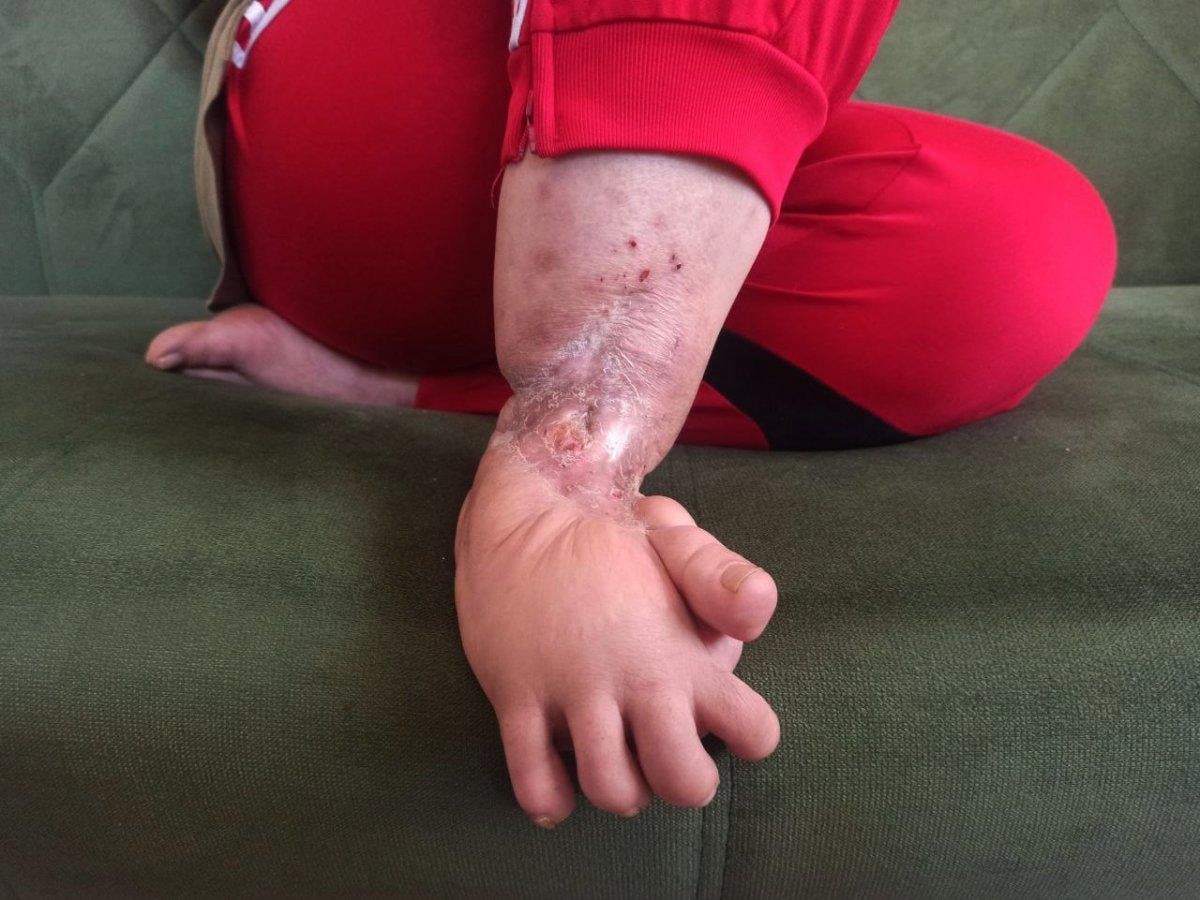 Mersin'de vücuduna iltihap yayılan kadın yardım bekliyor