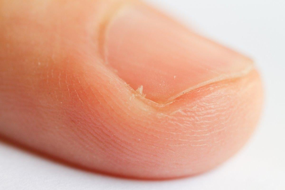 Ellerdeki iltihap riski: Şeytan tırnağı nedir? Şeytan tırnağı neden çıkar?