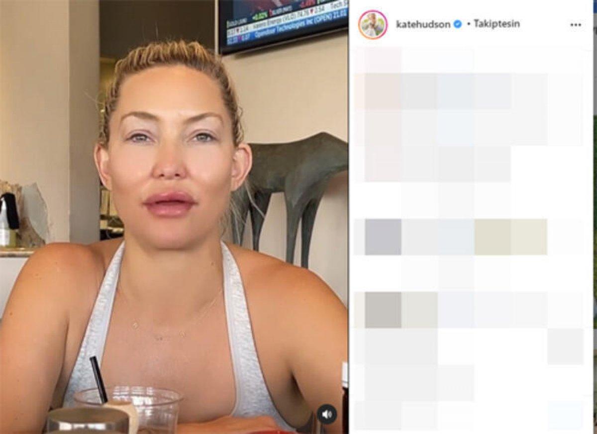 Kate Hudson'un botoks filtresi