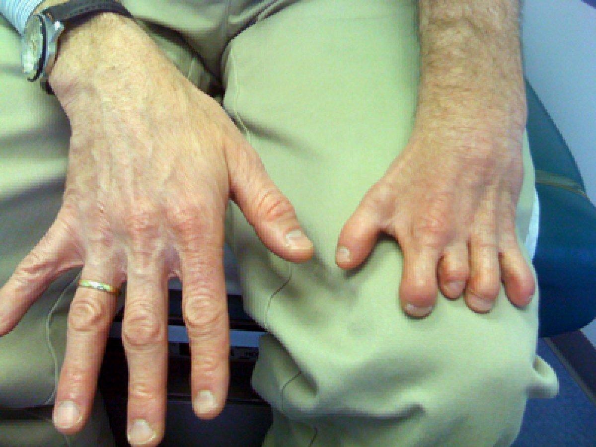 Göğüs duvarının deformitesi: Poland sendromu nedir?