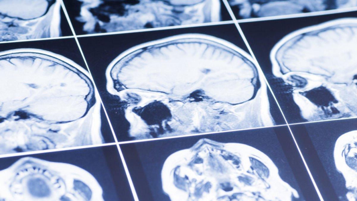 Koronavirüs geçiren 3 kişiden 1'inde beyin bozukluğu gelişiyor