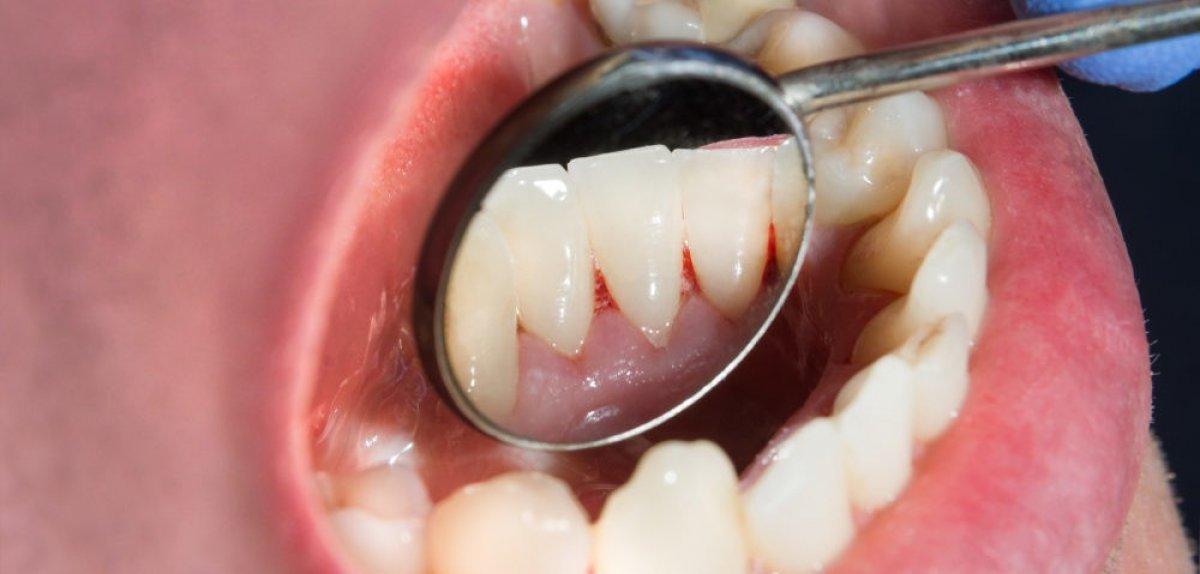 Ağızdaki demir tadı koronavirüs belirtisi midir? Ağızda metalik tat nedenleri