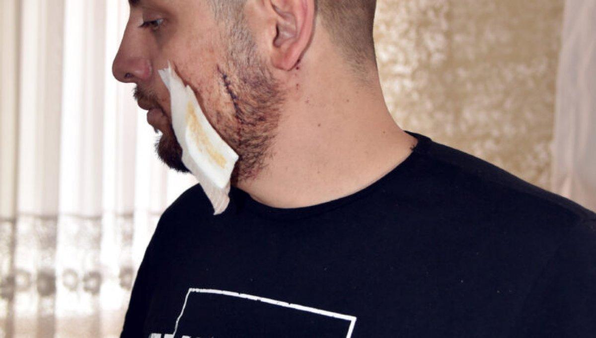 Antalya'da, kız arkadaşını döven şahsa müdahale edince yüzü parçalandı