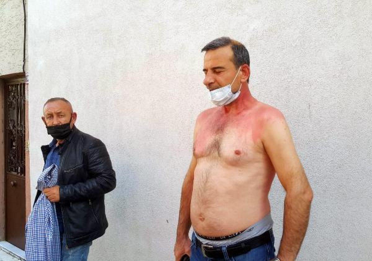 Edirne'de komşusunun üzerine kaynar su döktü