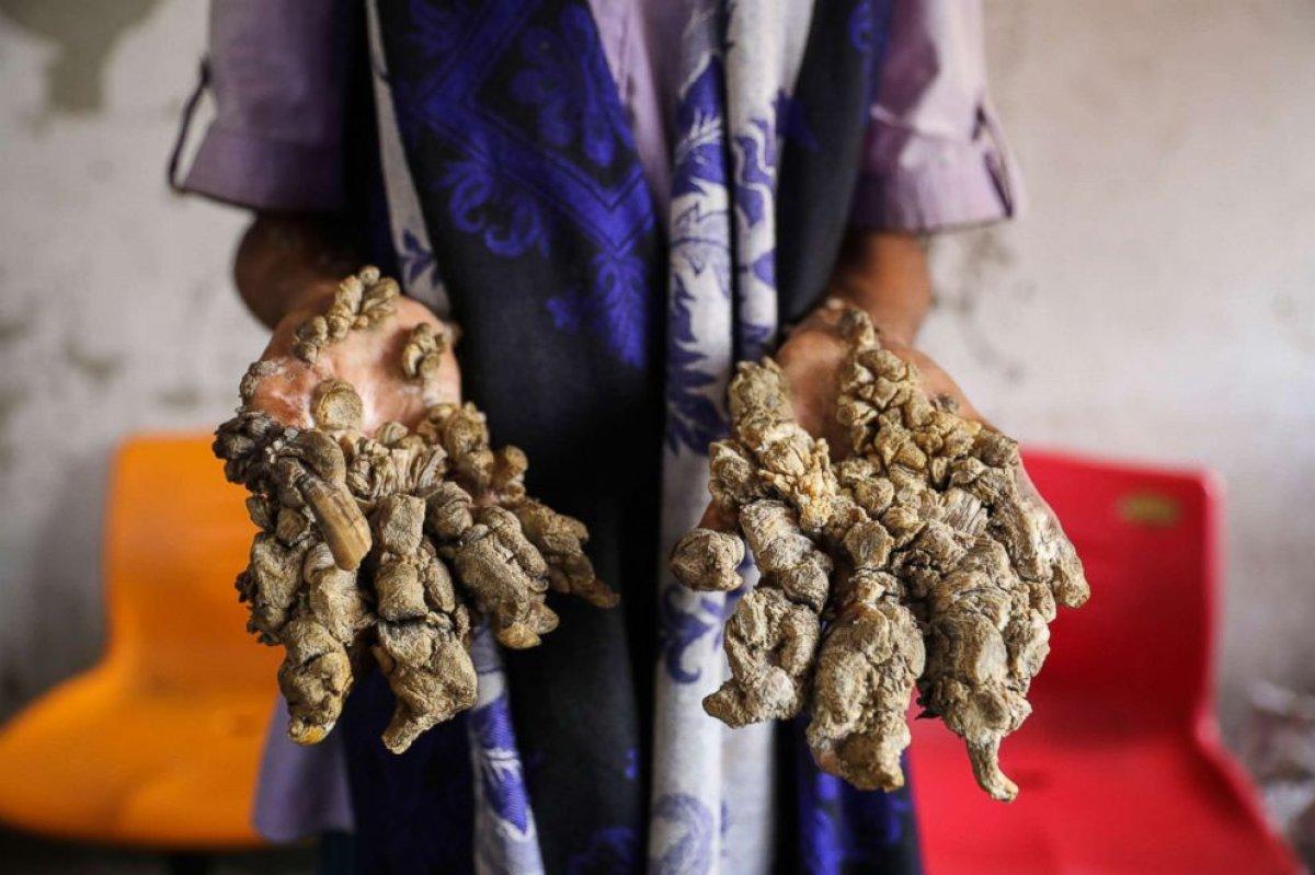 Dünyadaki en nadir hastalıklar