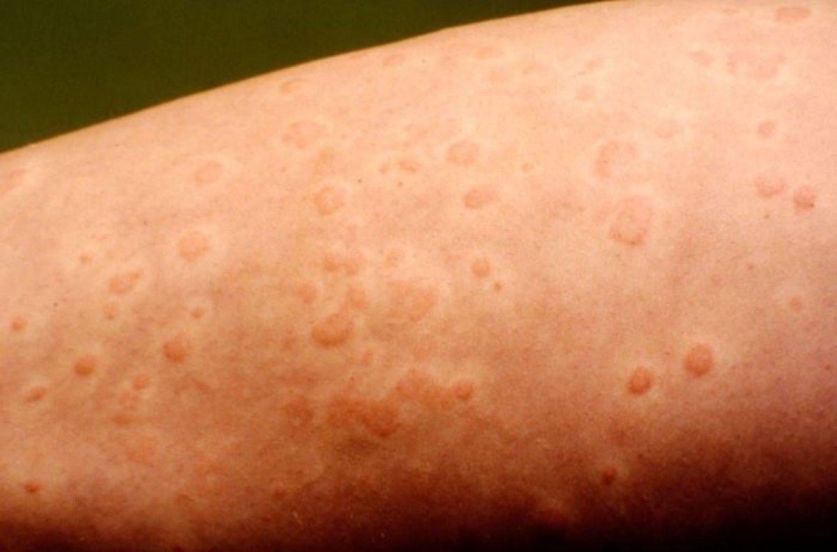 Dünyadaki en nadir hastalıklar