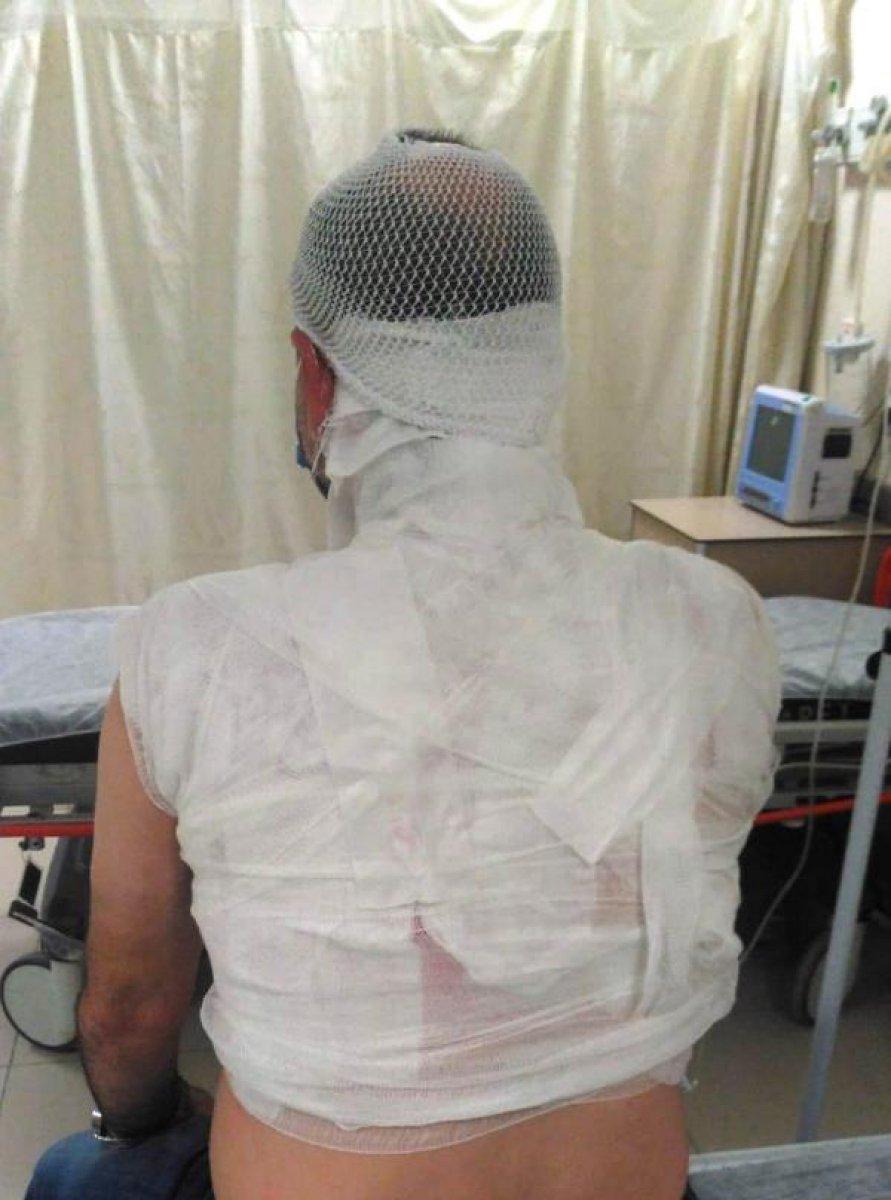 Edirne'de komşusunun üzerine kaynar su döktü