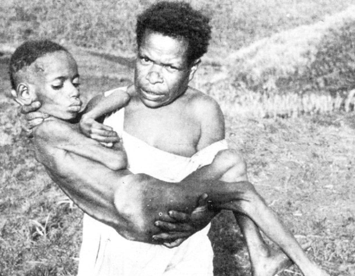 Dünyadaki en nadir hastalıklar