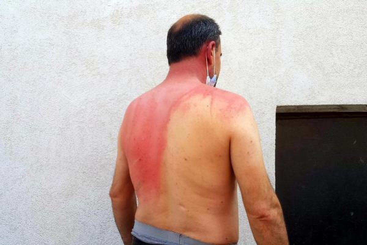 Edirne'de komşusunun üzerine kaynar su döktü