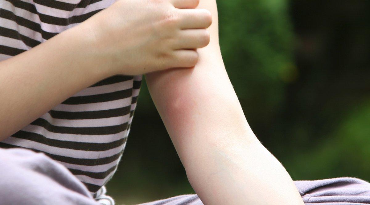 Semptomları Covid-19'la aynı: Kırım Kongo Kanamalı Ateşi belirtileri nelerdir?