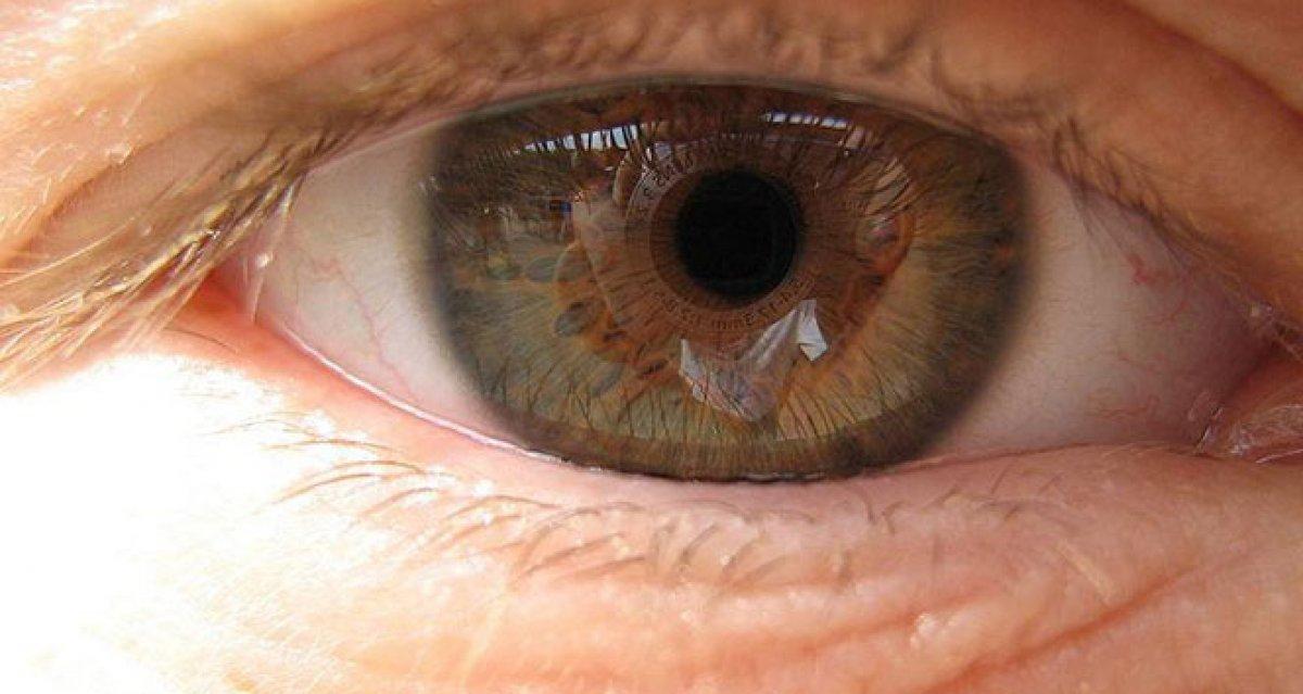 Kadınlarda sarı nokta hastalığı riski daha yüksek