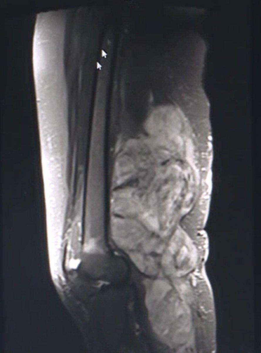 Erzurum’da varis sandığı bacağından 10 kilo tümör çıkarıldı