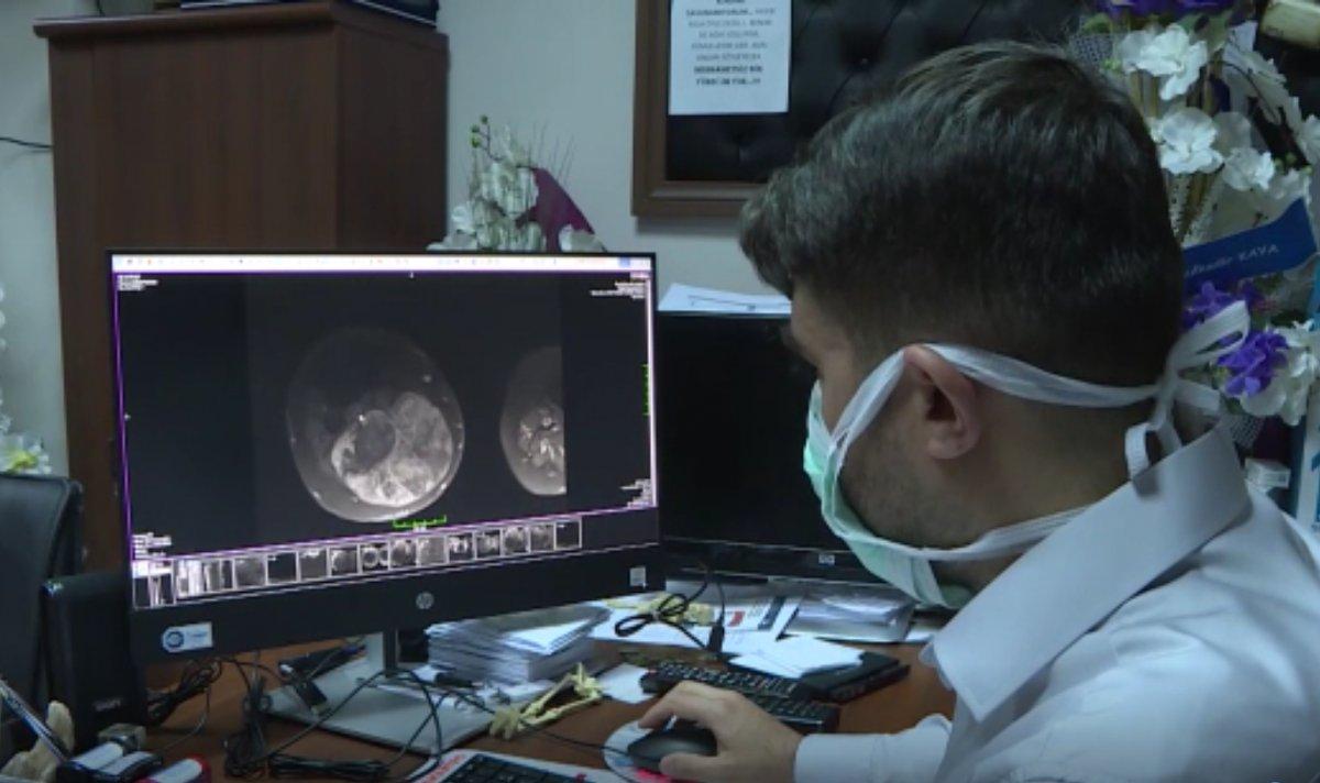 Erzurum’da varis sandığı bacağından 10 kilo tümör çıkarıldı