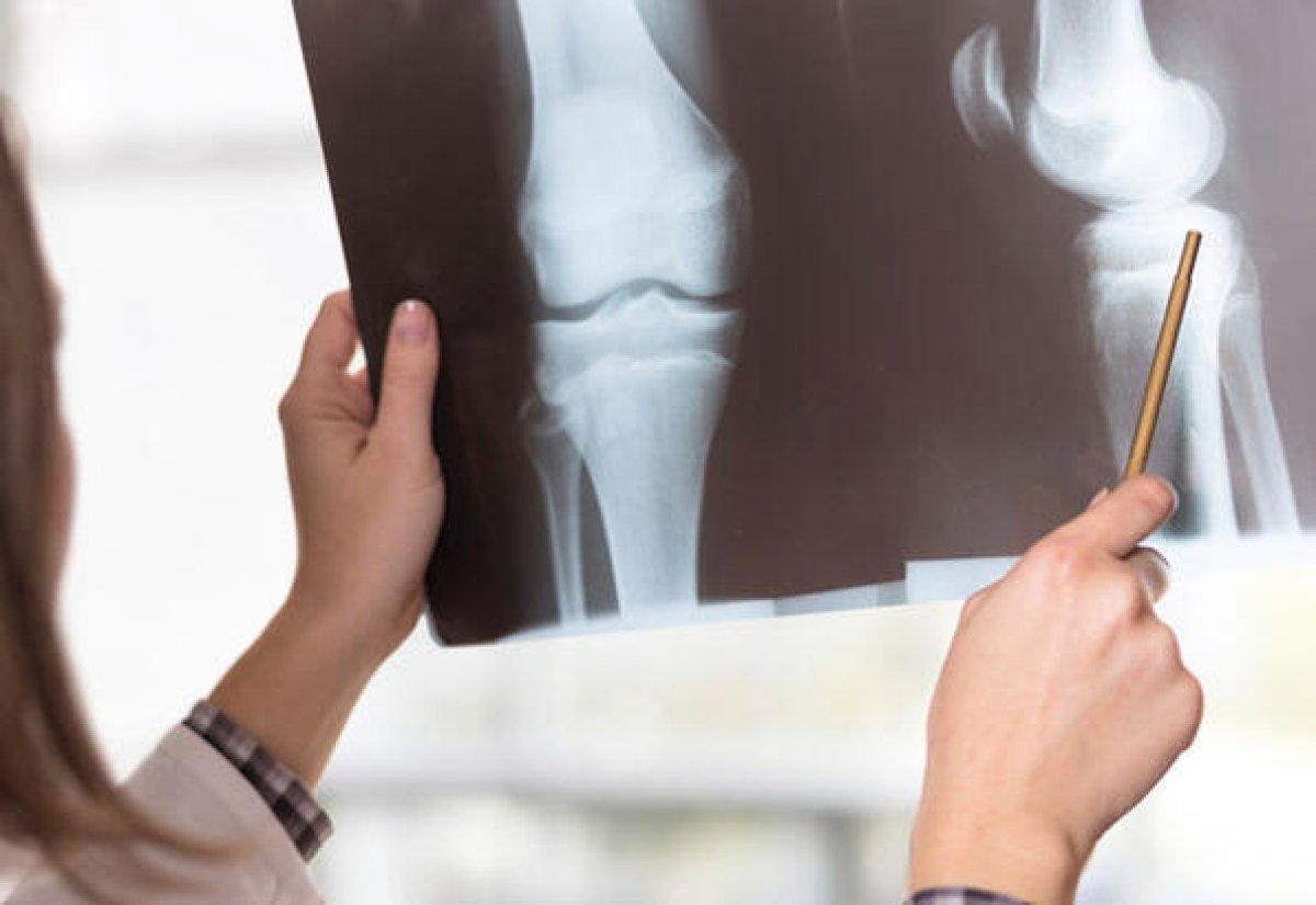 Sağlıklı kemikler için 7 besin